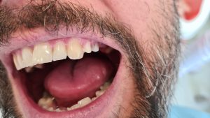 Bočné zuby po obrúsení - príprava na zubný mostík