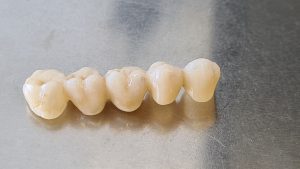Ako vyzerá zubný mostík